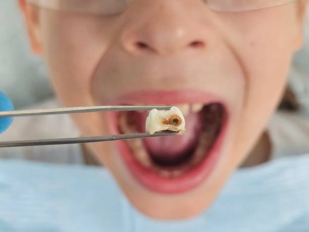 Best Emergency Treatment for Dental Infections or Abscesses in Preston, IA